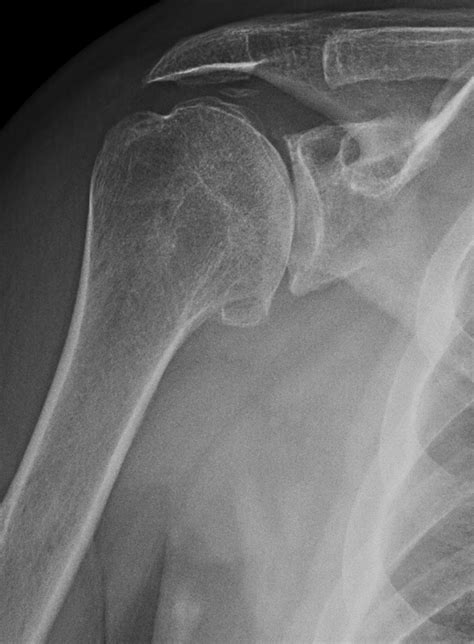 Uw Shoulder And Elbow Academy Shoulder Joint Replacement Humeral