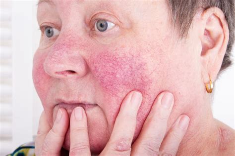 Rosacea Types Causes And Symptoms Wethinkhealthonline