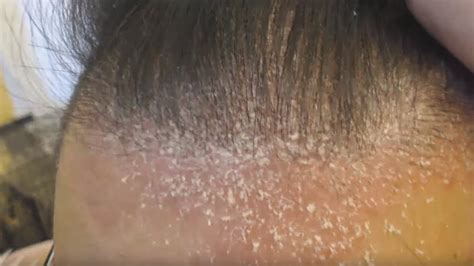 How To Remove Psoriasis Scales From Scalp