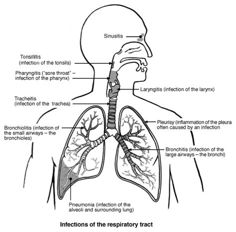 This commonly includes nasal obstruction, sore throat, tonsillitis, pharyngitis, laryngitis, sinusitis, otitis media. URTI - Upper Respiratory Tract Infection. Causes, symptoms ...