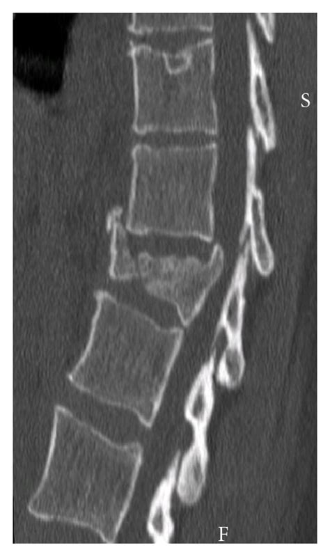 Imaging Of The Spine And Spinal Cord Concise Medical Knowledge