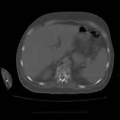Multiple myeloma is a monoclonal gammopathy and is the most common primary malignant bone neoplasm in adults. Multiple myeloma | Radiology Reference Article ...