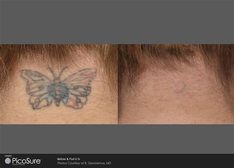 Picosure Laser Tattoo Removal Mansfield Cosmetic Surgery Center