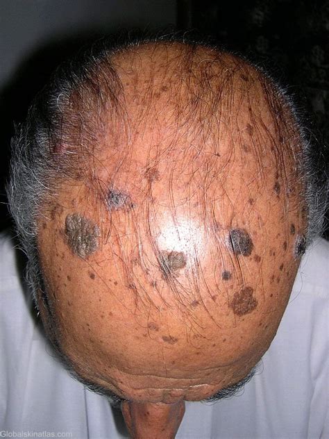 Skin Disease Types Seborrheic Keratosis Skin Disease Type