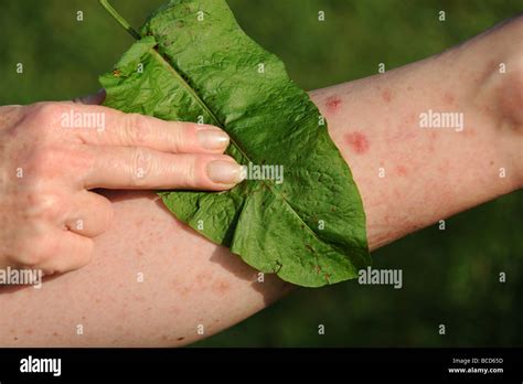 Treating A Nettle Sting With A Dock Leaf Stock Photo Alamy