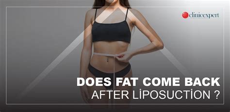 Can Fat Return After Liposuction Clinicexpert