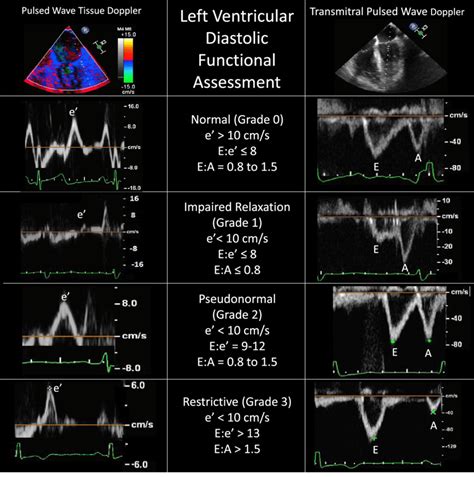 Lv Diastolic Function Echocardiography Iucn Water