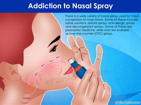 Decongestant nasal sprays cannot be used like saline nose sprays. Addiction to Nasal Spray: Treatment & Recovery of Rebound ...