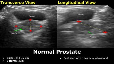 Solution Prostate Ultrasound Normal Vs Abnormal Image Appearances