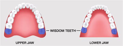 Wisdom Teeth Removal In Gosford 7 Days Vc Dental