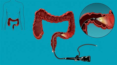 Whats A Sigmoidoscopy All About Testing And Diagnosis