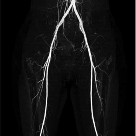 The Right Lower Extremity Arteriogram Showed A Complete Occlusion With