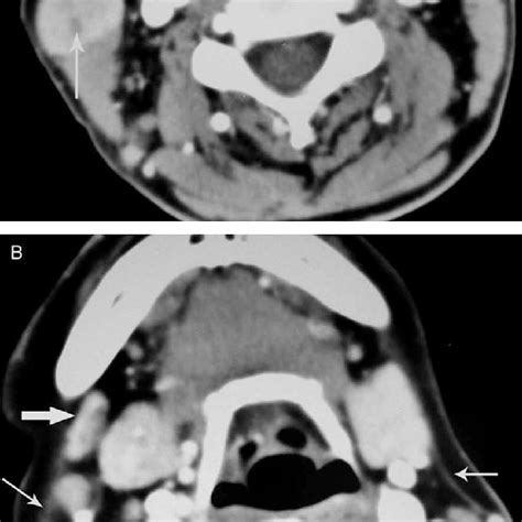 Pdf Tuberculosis Of The Parotid Gland Computed Tomographic Findings