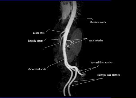 Anatomy Abdomen Arteriesmra Abdominal Arteries Anatomy