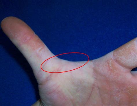 The Most Important Key To Keeping Your Thumb Skin From Tearing Diesel