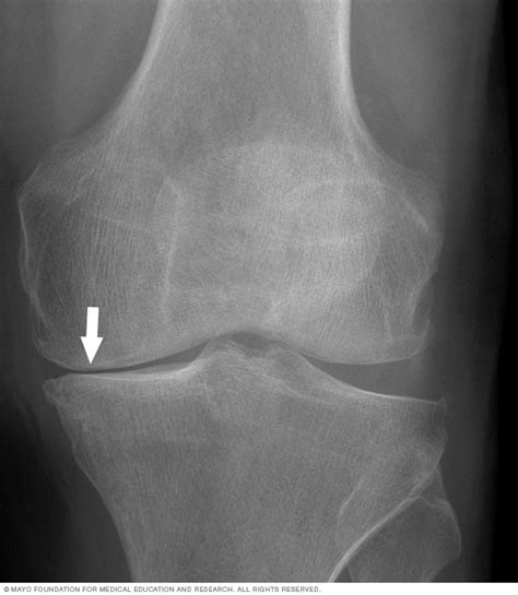 X Ray Of Knee Arthritis Mayo Clinic