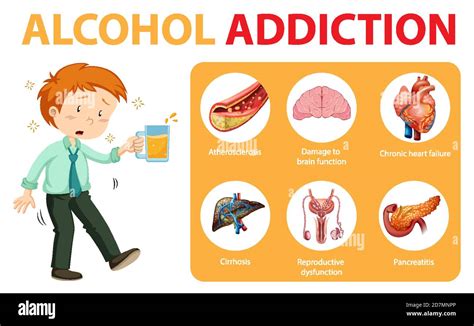 Alcohol Addiction Or Alcoholism Information Infographic Illustration Stock Vector Image And Art