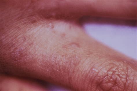 Scabies Infestation Skin Disorders Merck Manuals Consumer Version