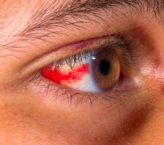 Valigetta trucco: Irritazione intorno agli occhi