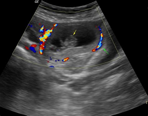 Ultrasound Evaluation Of Ectopic Pregnancy Eurorad