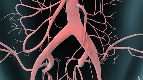 Un aneurisma aórtico es una protrusión anormal que se produce en la pared del vaso sanguíneo principal (aorta) que transporta la sangre desde el corazón hasta el cuerpo. Aneurisma aórtico abdominal - YouTube