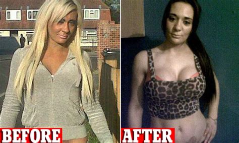 Model Josie Cunningham S Breast Op And You Foot The Bill Outrage As The NHS Provides