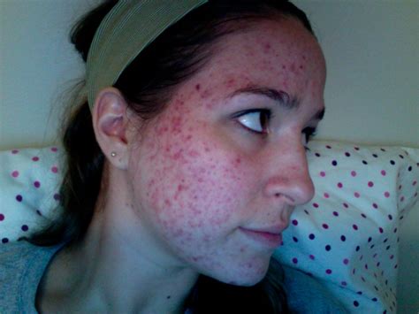The Secret That Cleared My Severe Hormonal Cystic Itchy Adult Acne