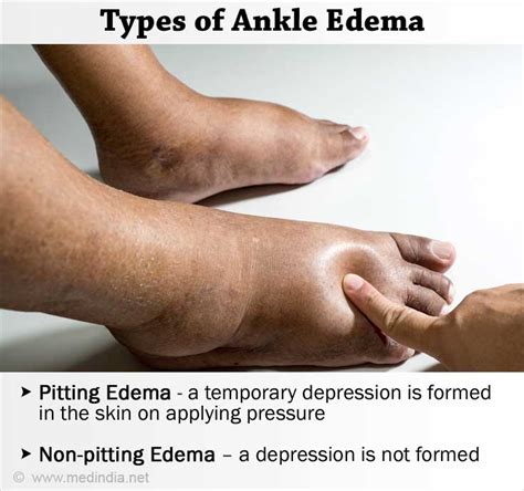 Ankle Edema Ankle Swelling Causes Faqs
