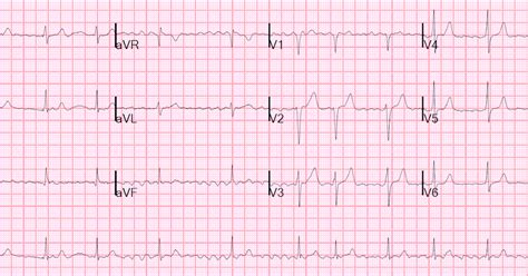 Dr Smiths Ecg Blog Syncope And Atrial Fibrillation In A Healthy 70