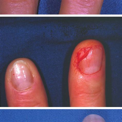 Above Partial Fingernail Defect After Trauma Center Excision Of