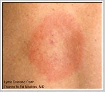 Black widow bite symptoms & treatment. treatment for cellulitis: treatment for cellulitis from ...