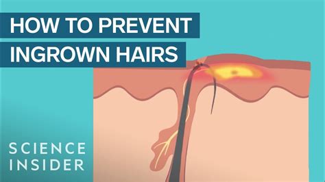 What Are Ingrown Hairs And How To Treat Them Science Metro