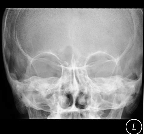 Paranasal Sinuses X Ray Lateral