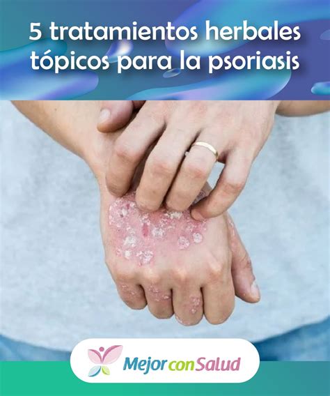 Arriba 95 Foto Fotos De Psoriasis En Las Manos Mirada Tensa 092023