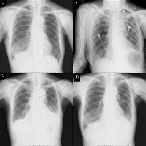 Preoperative A And Postoperative B Inhalation X Rays Showing