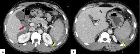 Cureus Spontaneous Splenic Rupture In Malaria Patients Two Case Reports