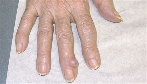 Derm Dx Semi Translucent Tumor On The Finger Clinical Advisor