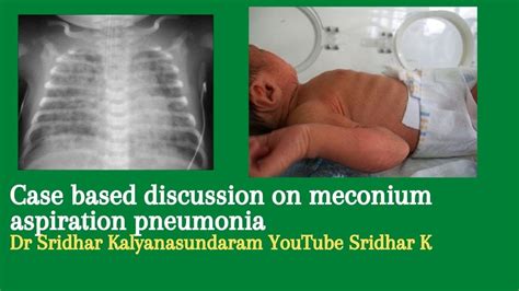 Meconium Aspiration Pneumonia Neonatal Mas Dr Sridhar K Youtube