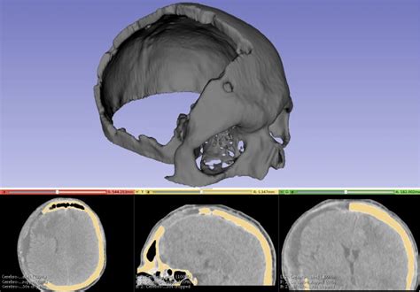 Depicts The 3d Cropped Skull Defect Segmented From A Tomography Image
