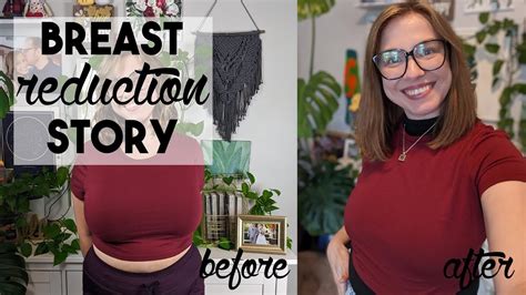 My Breast Reduction Story Pounds Removed Youtube