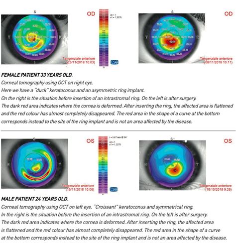 What Is Keratoconus Eye Disease Treatment Causes Symptoms