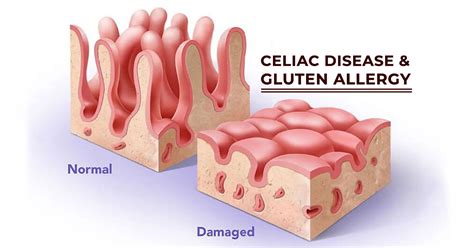 Facts About Celiac Disease And Gluten Intolerance Marham