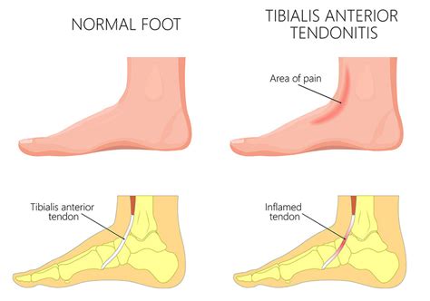 Anterior Tibial Tendonitis Causes Symptoms And Treatment Options