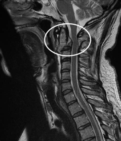 Cervical Spine Hangman Fracture Secondary To A Gelastic Seizure Bmj