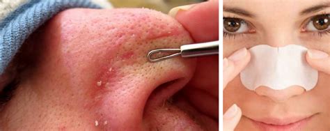 A Step By Step Guide To Blackhead Removal