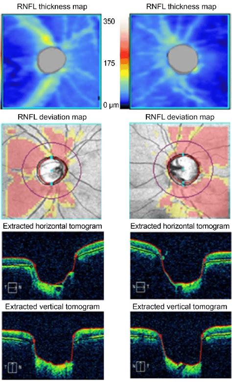 Results Of Rnfl Optical Coherence Tomography Oct Rnfl Oct Showed