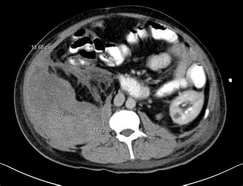 Ct Abdomen Showing Retroperitoneal Hematoma Download Scientific Diagram