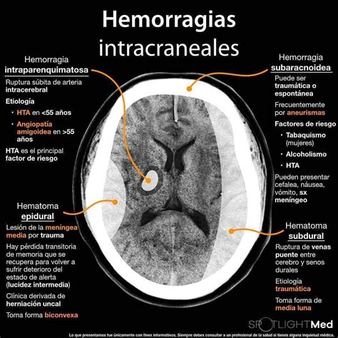 Tipos De Hemorragia Cerebral