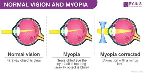 Eye Defects Myopia Its Causes Symptoms And Treatment