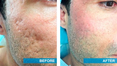 Regaining Confidence With Acne Scar Treatment Dermatology Consultants